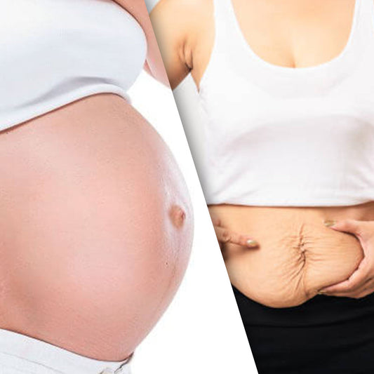 Skincare for Stretch Marks during and after Pregnancy