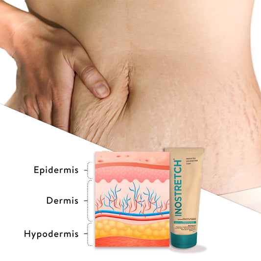 Revolutionary Rutin for Rigid Stretchmarks and Scars
