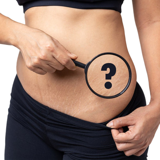 Skin and beyond: Can stretch marks be erased permanently?