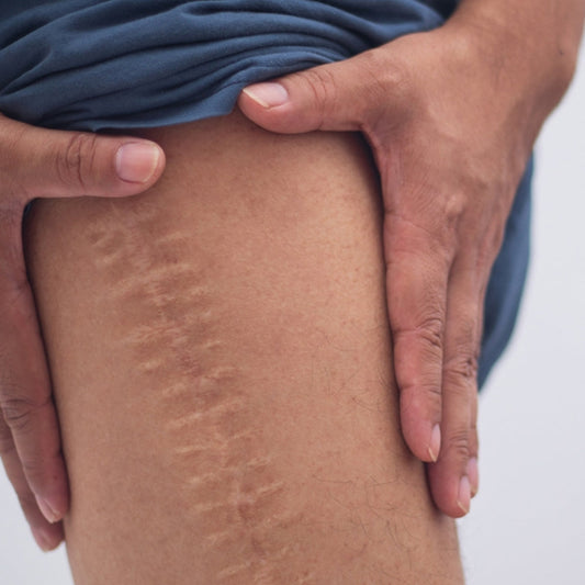 Close-up of a skin scar showing texture and healing pattern, illustrating types of scars and skin recovery process.