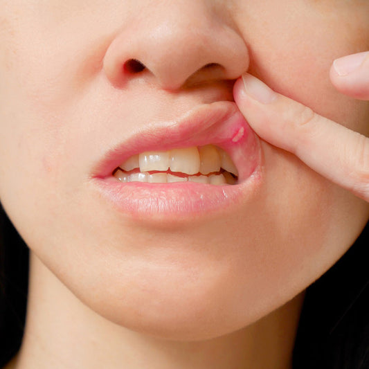 Say Goodbye to Mouth Ulcers with These Home Remedies
