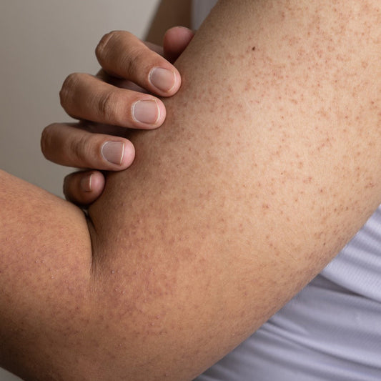 Close-up of arm with strawberry skin texture showing dark pores and small bumps on skin.