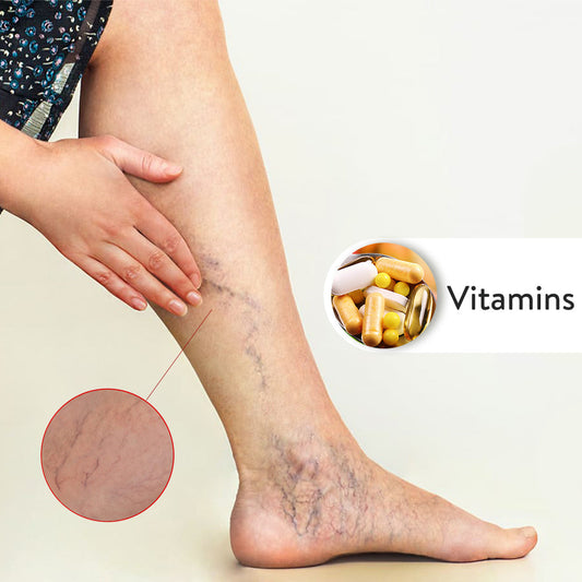 Vitamins For Varicose Vein