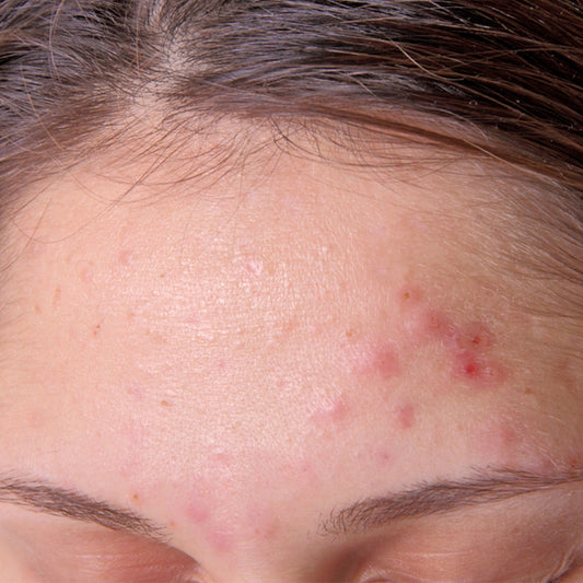 Forehead Acne: Cause, Treatment & Precautions