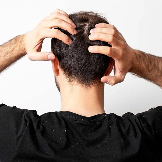 Get Rid of Dandruff with Simple Home Remedies