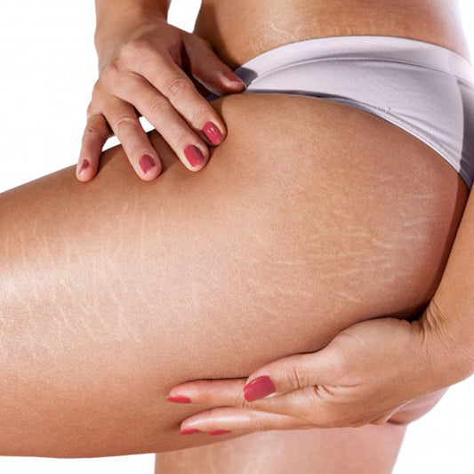 Who Should Be Using Anti-Stretchmarks Cream!