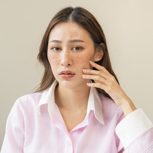 12 Superfoods You Must Try to Clear up Acne