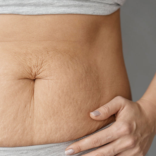 Debunk Common Myths About Stretch Marks