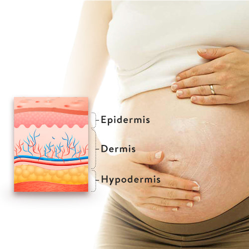 Which Skin Is More Prone To Stretchmarks?