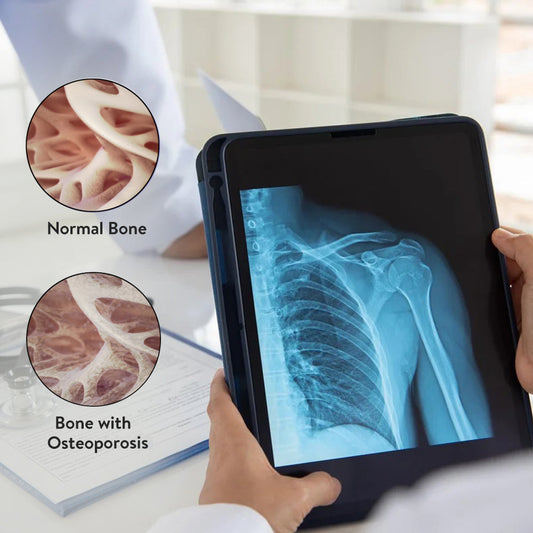 How to Avoid Osteoporosis in Advance