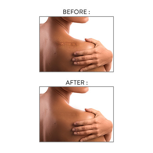 Achieving The Best Result From Scar Treatment